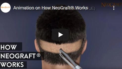 Video on The NeoGraft Procedure Click to See