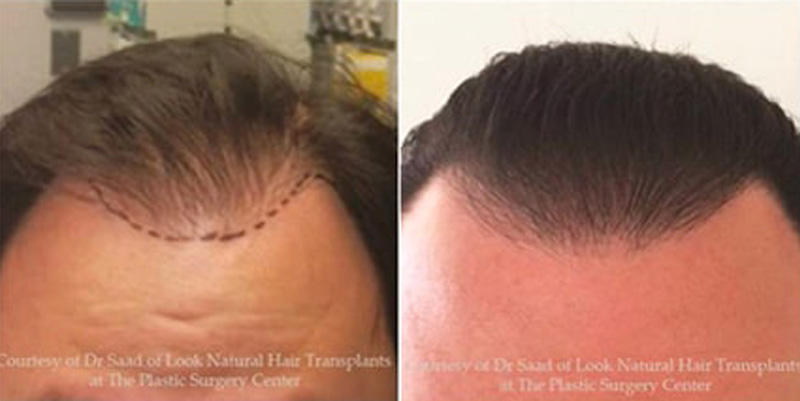 Before and after photos of a patient front view who undergone hair transplant