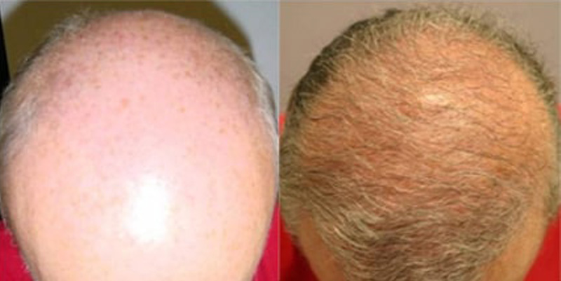 Before and after photos of a patient top side view who undergone hair transplant
