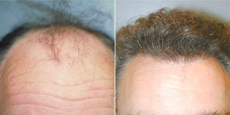 Before and after photos of a patient front view who undergone hair transplant