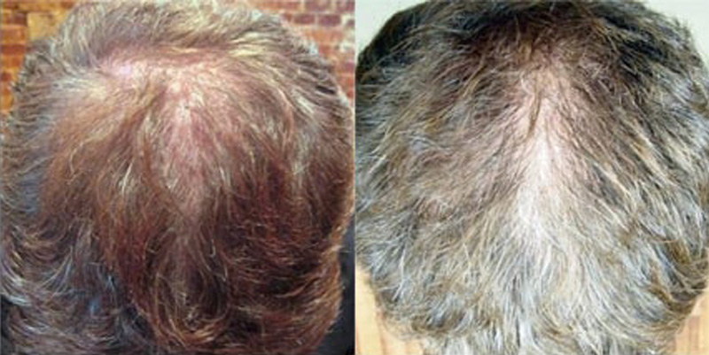 Before and after photos of a patient top view who undergone hair transplant