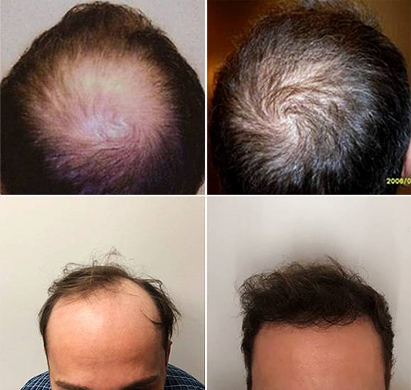 Get your hair back before after image