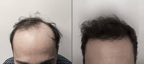 Before and after photos of a patient front view who undergone hair transplant