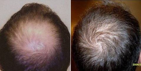 Before and after photos of a patient back side view who undergone hair transplant