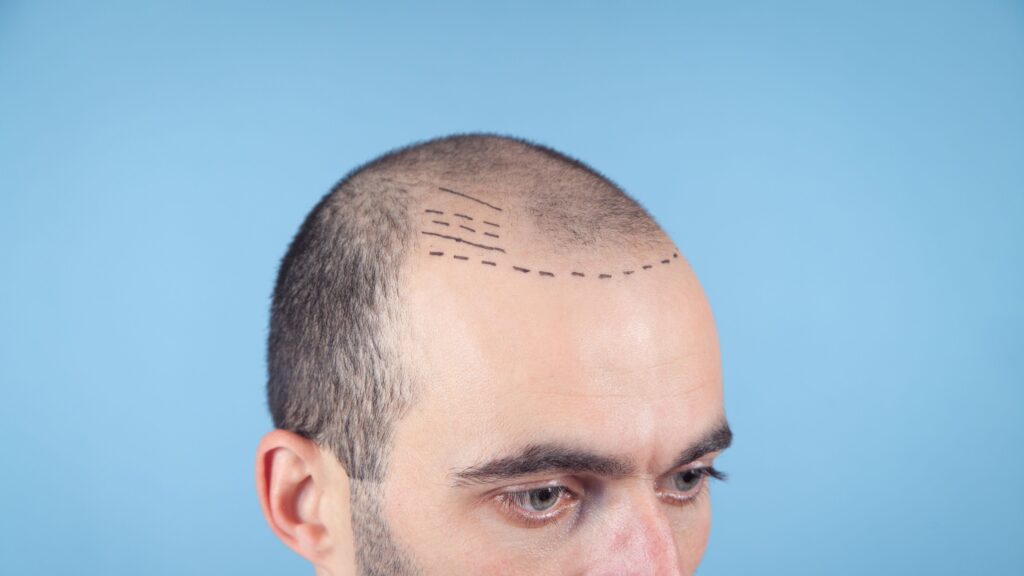 Hair transplant Houston Neograft