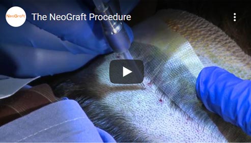 Video on The NeoGraft Procedure Click to See