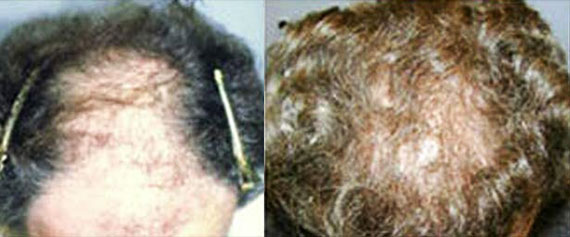 Before and after photos of a patient top side view who undergone hair transplant