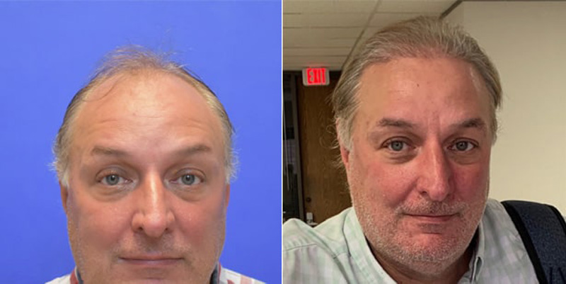 Before and after photos of a patient front side view who undergone hair transplant