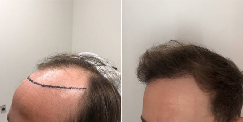 Before and after photos of a patient left side view who undergone hair transplant