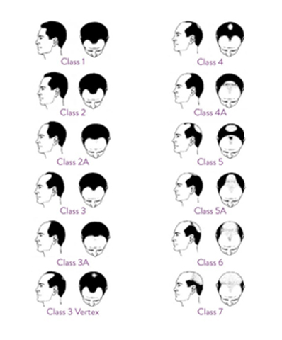 Norwood Hair Loss Scale